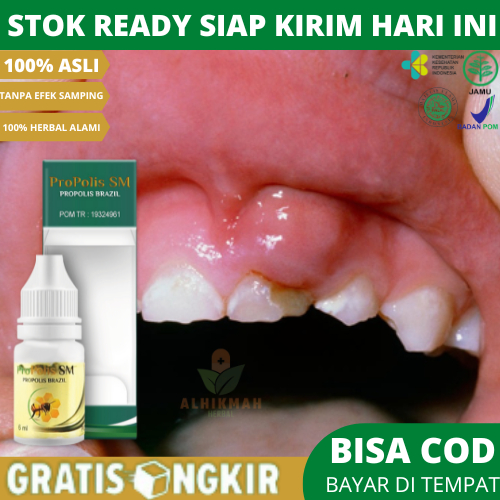 Obat Tetes Abses Gigi / Abses Gusi Untuk Anak & Dewasa, Obat Benjolan Gusi, Obat Gusi Bengkak, Berna
