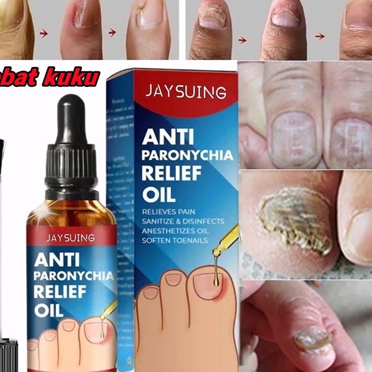 obat kuku jamur dan rusak vitamin kuku 10ml obat jamur kuku Perawatan Jamur Kuku Paronychia Perawata
