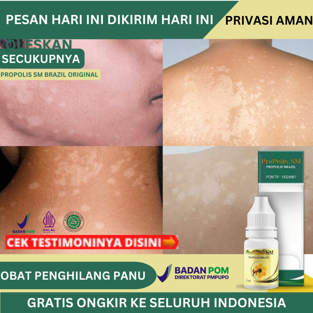 Obat Penghilang Panu, Obat Panu Di Wajah, Obat Oles Cair Penghilang Panu, Bercak Putih Di Wajah, Di 