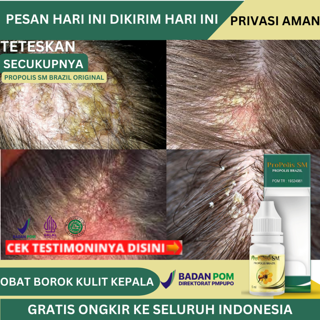 Obat Borok Di Kepala, Obat Borok Kulit Kepala Anak Dan Dewasa, Obat Koreng Di Kepala,Obat Kulit Kepa