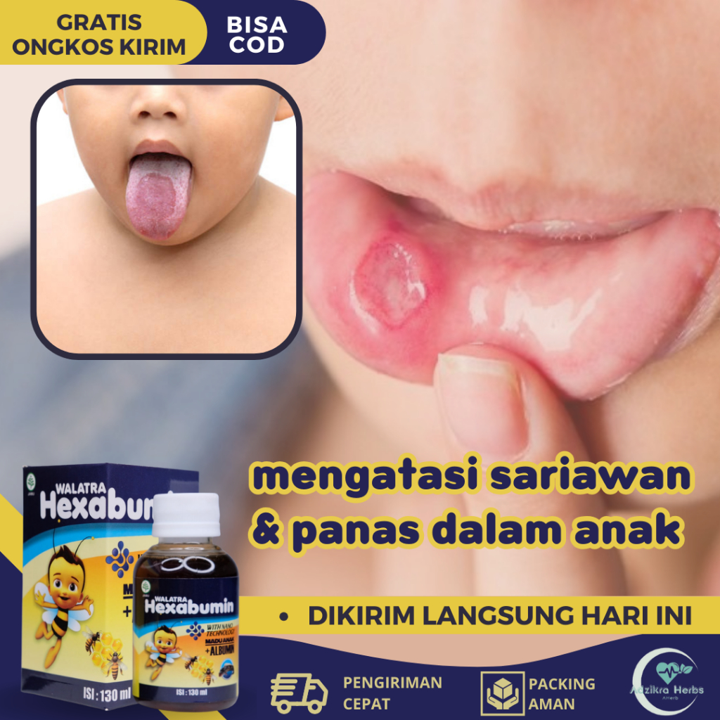 Obat Sariawan Anak, Obat Panas Dalam Anak, Obat Sariawan Di Lidah Mulut Bibir Anak, Obat Jamur Putih