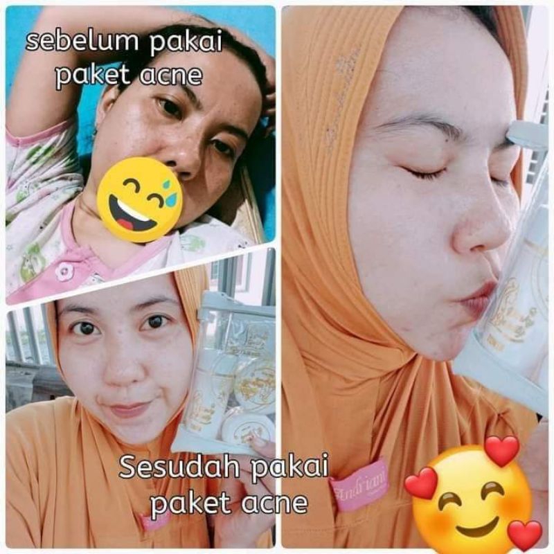 CreamAcne Pinky Beauty Original By Hj ImeldaYunus