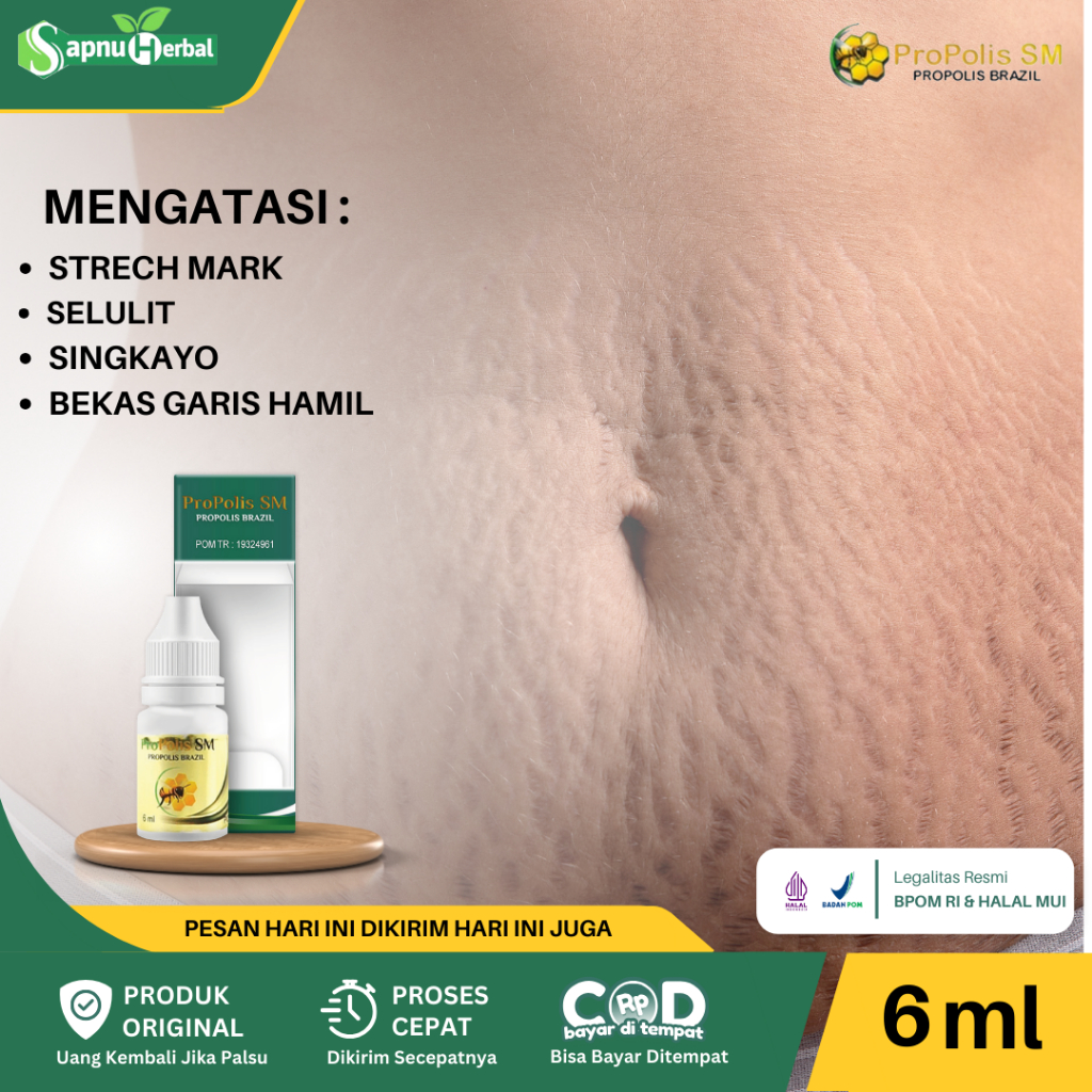 Obat Stretch Mark, Singkayo di Paha Betis, Guratan/Garis Di Kulit, Penghilang Bekas Luka Strech Mark