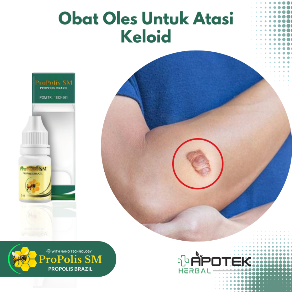 Obat Keloid Daging Jadi Daging Tumbuh Keloid Bekas Operasi Keloid Luka Tindik di Telinga Keloid Inje