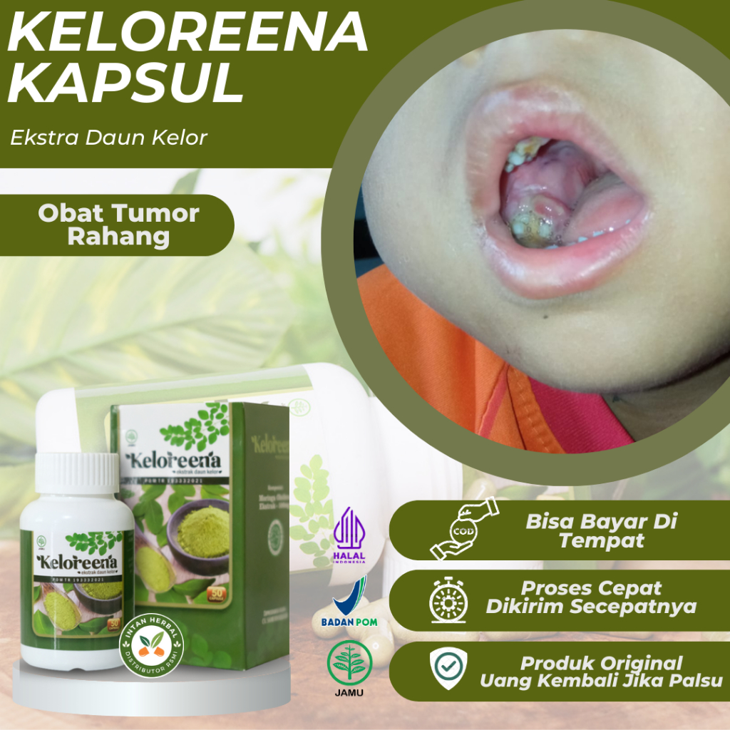 Keloreena Kapsul 100% Original - Obat Tumor Rahang, Benjolan Di Rahang Mulut, Kanker Mulut Stadium 1