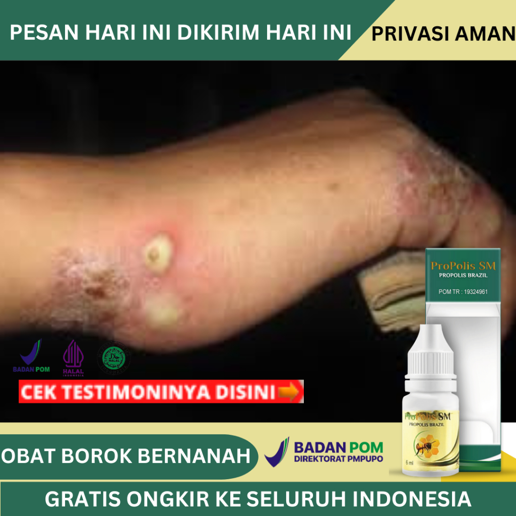 Obat Borok Bernanah, Obat Budug Bernanah, Obat Gudik, Obat Salep Gudik, Obat Borok, Cenang, Koreng B