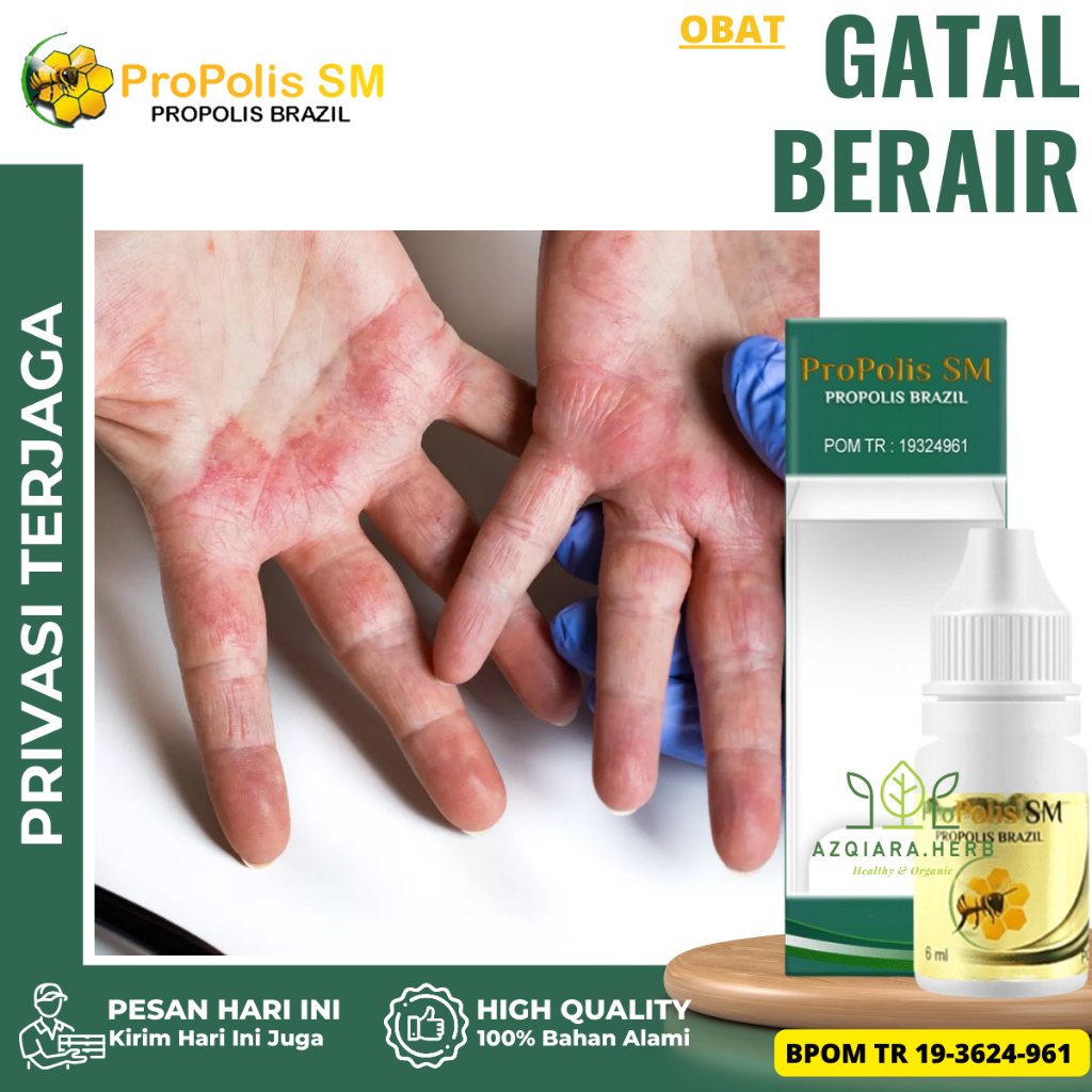 Obat Gatal Berair, Obat Kulit Gatal Berair, Obat Tangan Gatal Berair, Obat Penghilang Gatal Berair, 