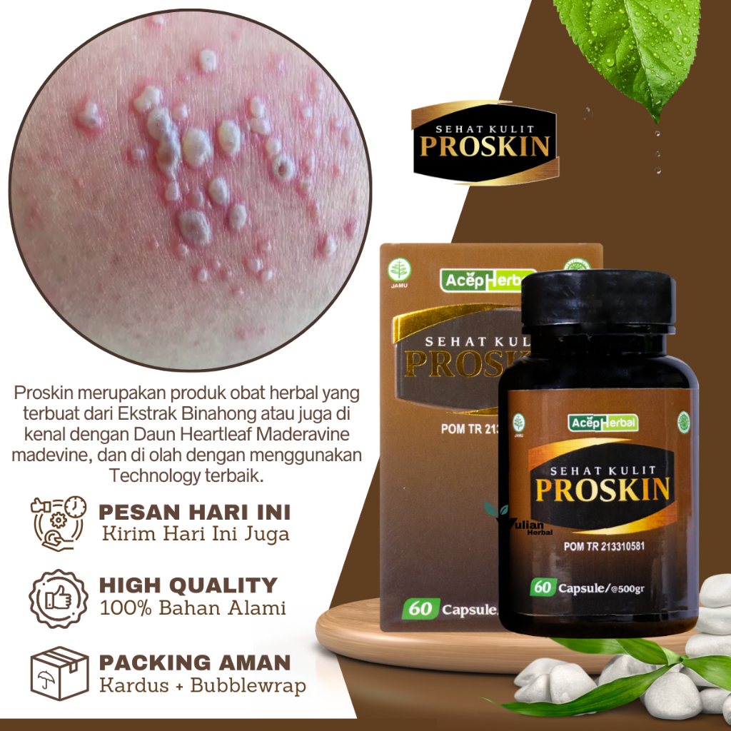 Obat Herpes Zoster, Obat herpes Genital, Obat Herpes Kulit, Obat Herpes Di Bibir, Obat Herpes Kelami