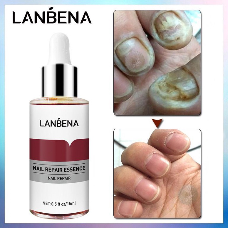BIG SALE FASION READY MURAH OBAT KUKU SERUM JAMUR KUKU SERUM LANBENA PERBAIKAN LANBENA NAIIL REPAIR 