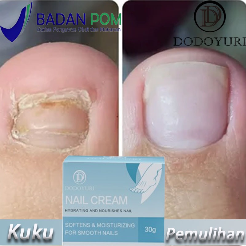 【BPOM】Obat jamur kuku Obat kuku jamur dan rusak Obat kuku Obat jamur kuku kaki 30g Obat jamur kuku t