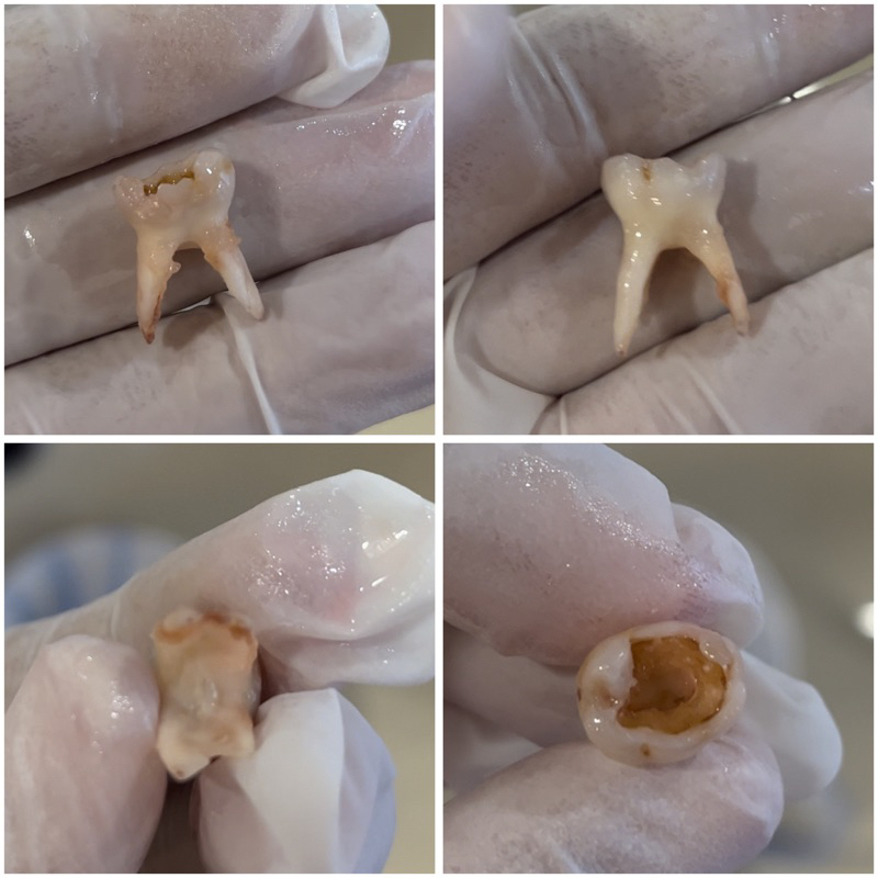 gigi molar sulung/gigi molar susu/gigi geraham susu