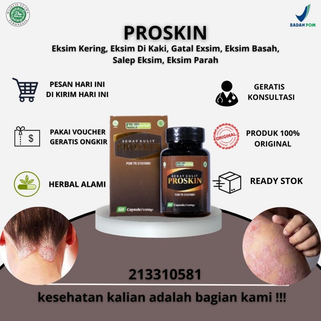 Obat Eksim Kering, Eksim Di Kaki, Gatal Exsim, Eksim Basah, Salep Eksim, Eksim Parah, Exsim Kering B