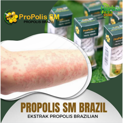 Propolis Sm - Obat Penghilang Gatal Alergi Alergi Makanan Semen Dingin Kayu Keringat