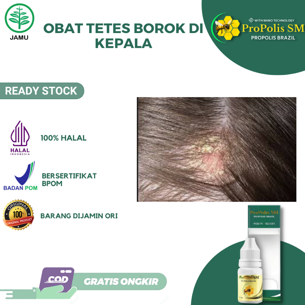 Obat Borok di Kepala Gatal Kulit Kepala Psoriasis Dermatitis Seboroik Kulit Kepala Berkerak Obat Tet