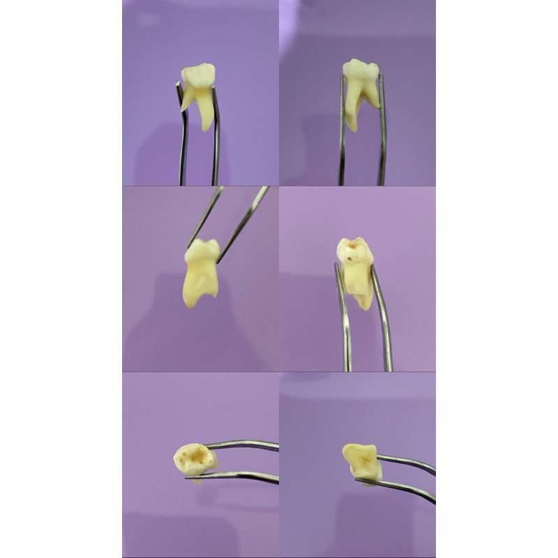 Gigi Sulung Anak Buka Kavum / Bukav Gigi Asli Praktikum