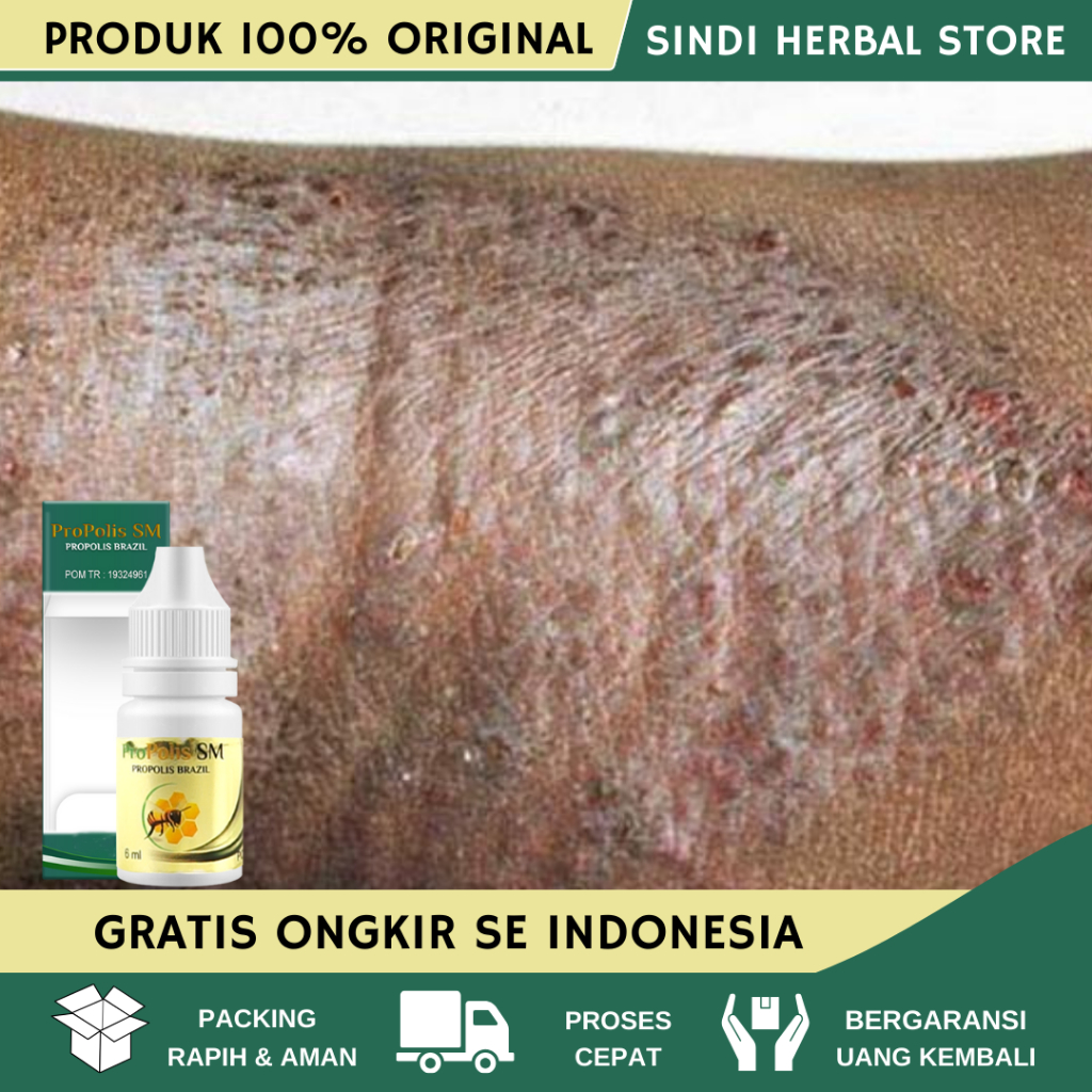 Obat Eksim Kering Menahun, Obat Eksim Basah Dan Kering Menahun, Obat Eksim Gatal, Obat Eksim, Obat E