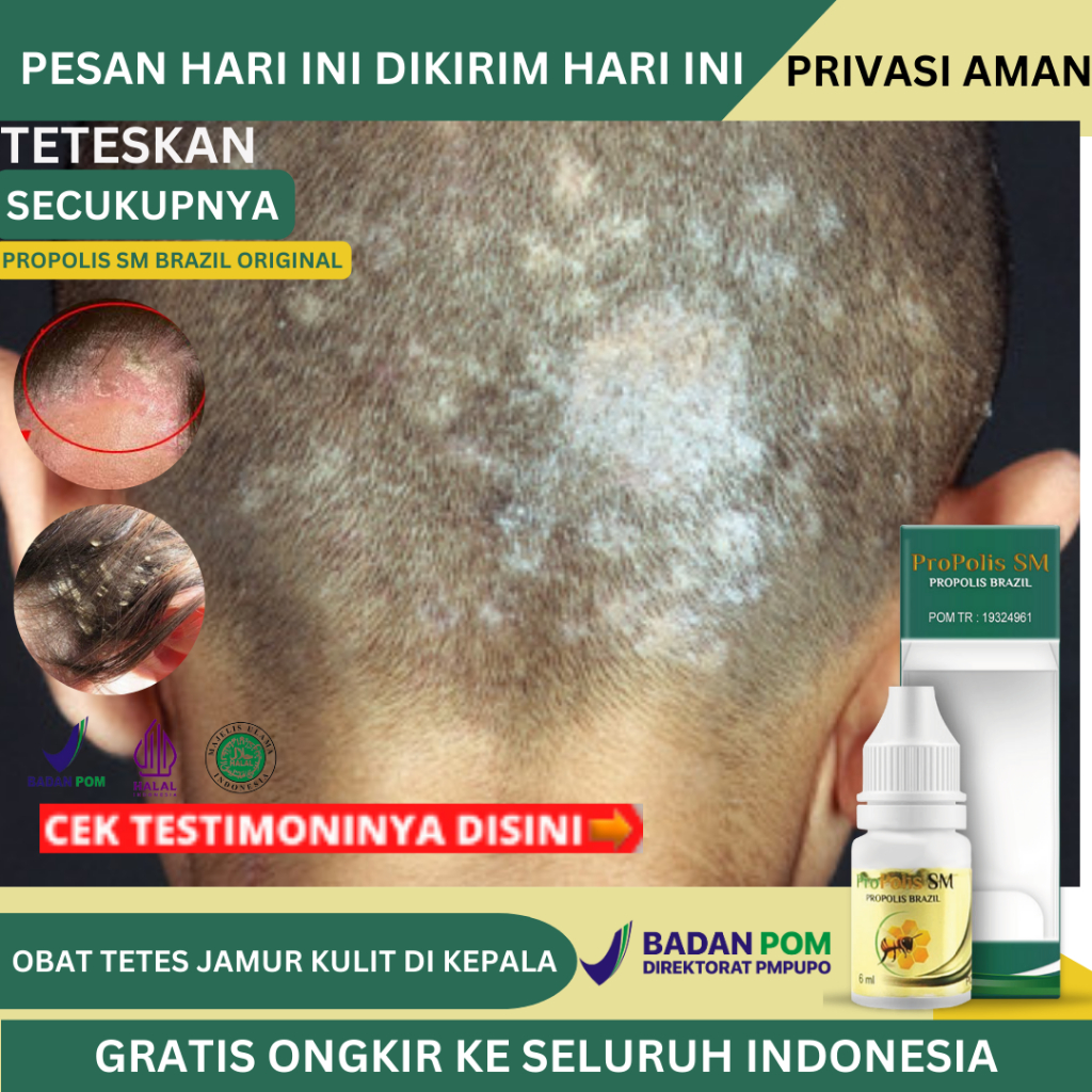 Obat Jamur Kulit Di Kepala, Obat Gatal Kulit Kepala, Obat Tetes Kulit Kepala Berjamur, Obat Psoriasi