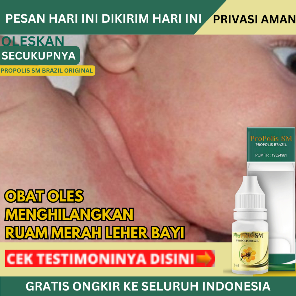 Obat Ruam Merah Lecet Perih Berair Dan Bau Di Lipatan Leher Bayi - Propolis SM