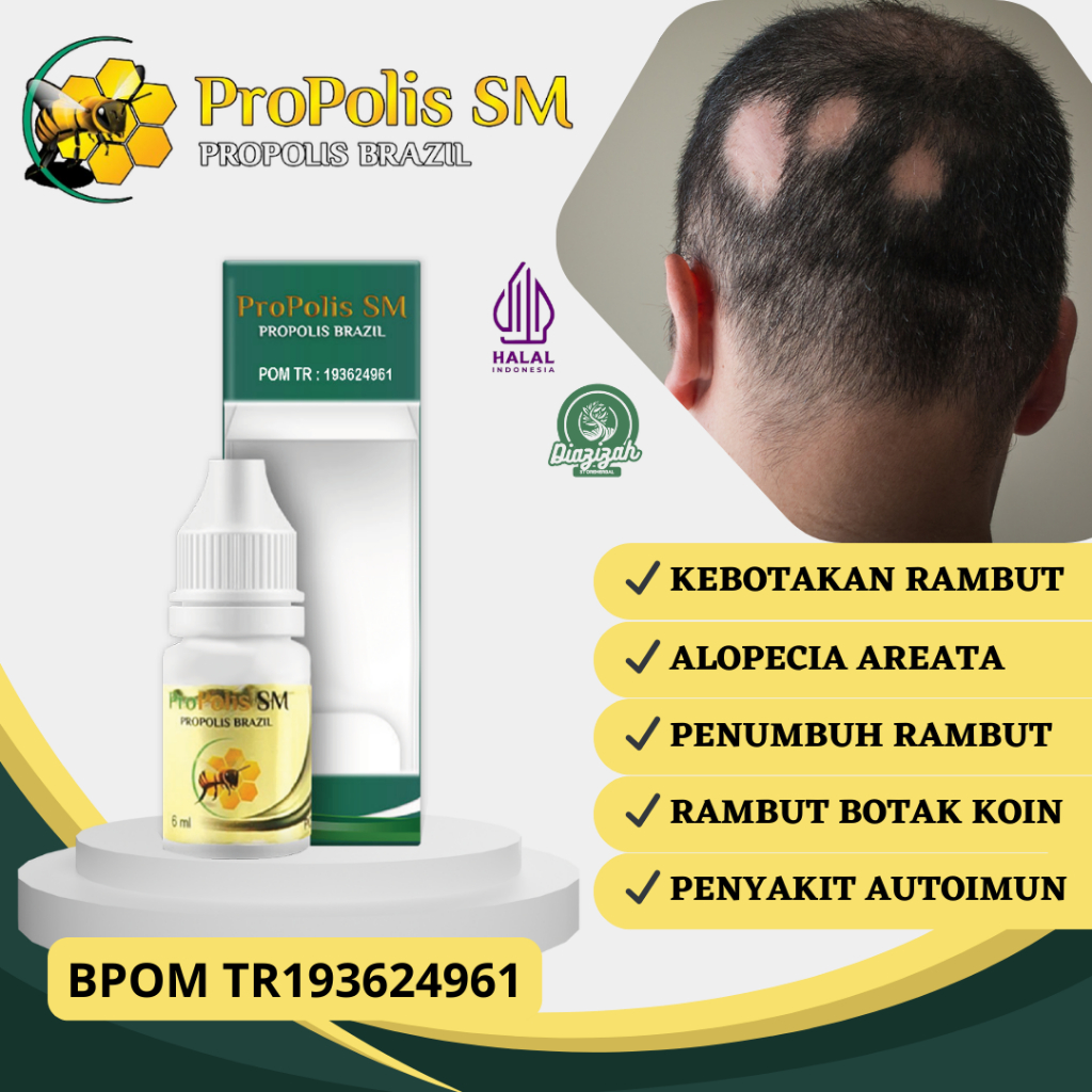 Obat Kebotakan Rambut, Obat Penumbuh Rambut Botak Koin, Obat Alopecia Areata, Obat Penumbuh Rambut P