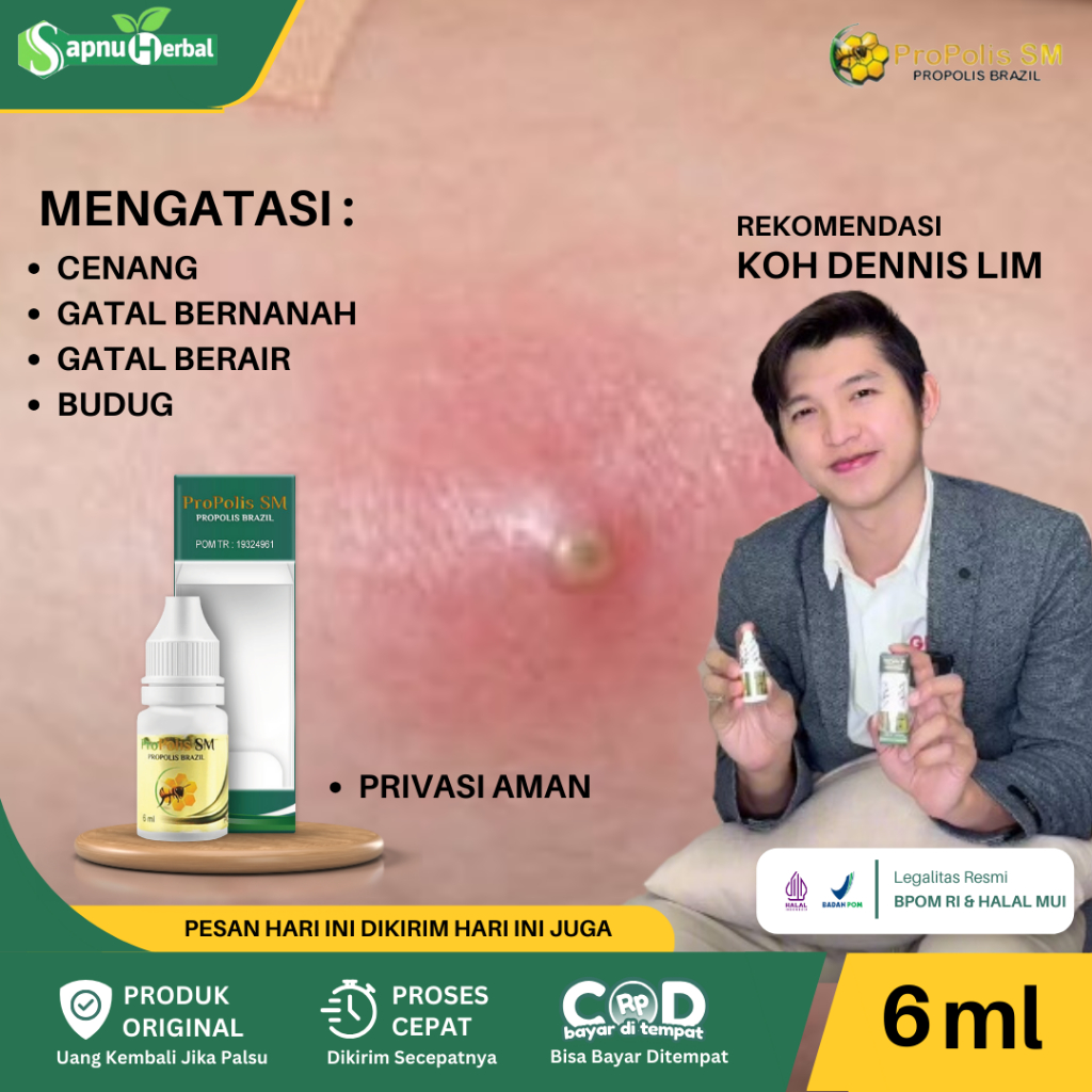 Propolis SM Obat Cenang Bernanah, Cenang Di Tangan & Kaki, Cenang Di Telapak Tangan Kaki, Koreng Ber