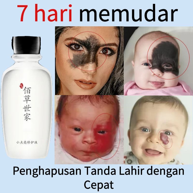 Memudarkan Tanda Lahir Obat Penghilang Tanda Lahir Coklat, Merah, Hitam Hemangioma Tanda Lahir Merah