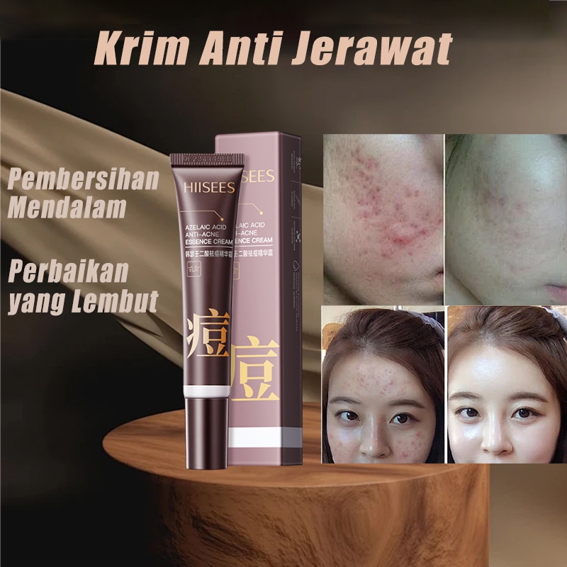 Krim Ampuh Penghilang Jerawat Acne Cream  Menghilangkan Jerawat dan Bekas Jerawat Bruntusan Cepat