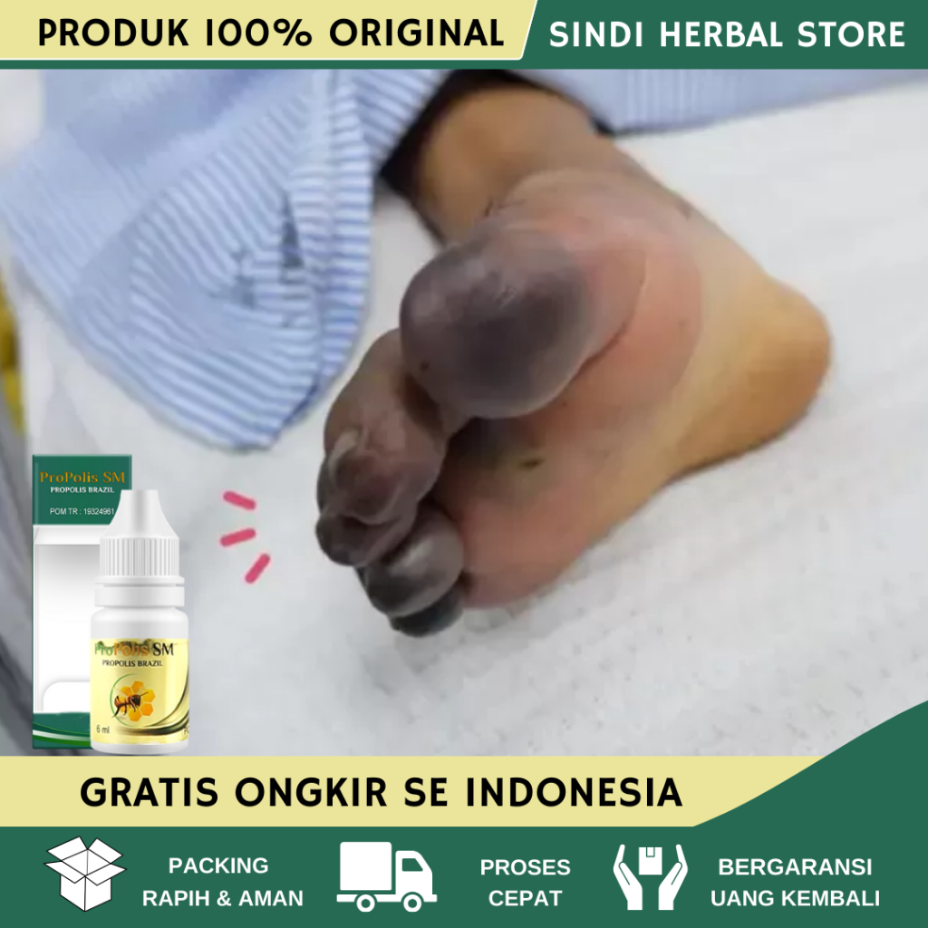 Obat Luka Diabetes, Obat Luka Diabetes Agar Cepat Kering, Diabetes Melitus, Gula Darah Tinggi, Luka 