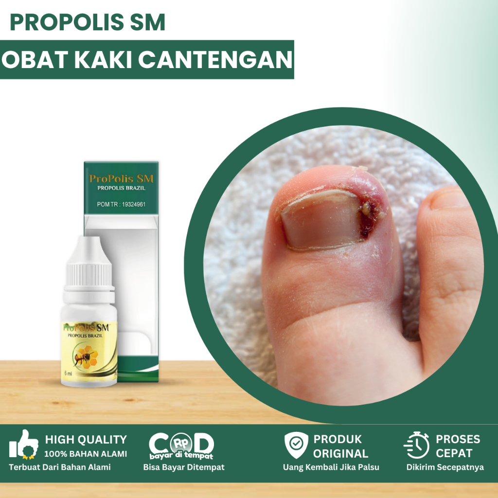 Obat Kaki Cantengan, Obat Cantengan Jempol Kaki, Obat Cantengan Bernanah, Obat Kuku Rusak, Jempol Ka