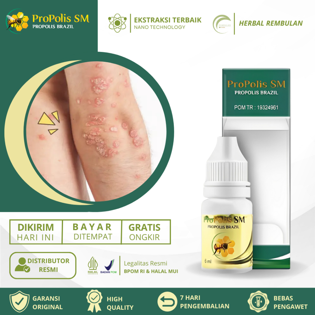 Obat Gatal Eksim, Obat Eksim Kering Menahun, Obat Eksim Basah, Obat Eksim Gatal Lecet Dan Hitam Di S