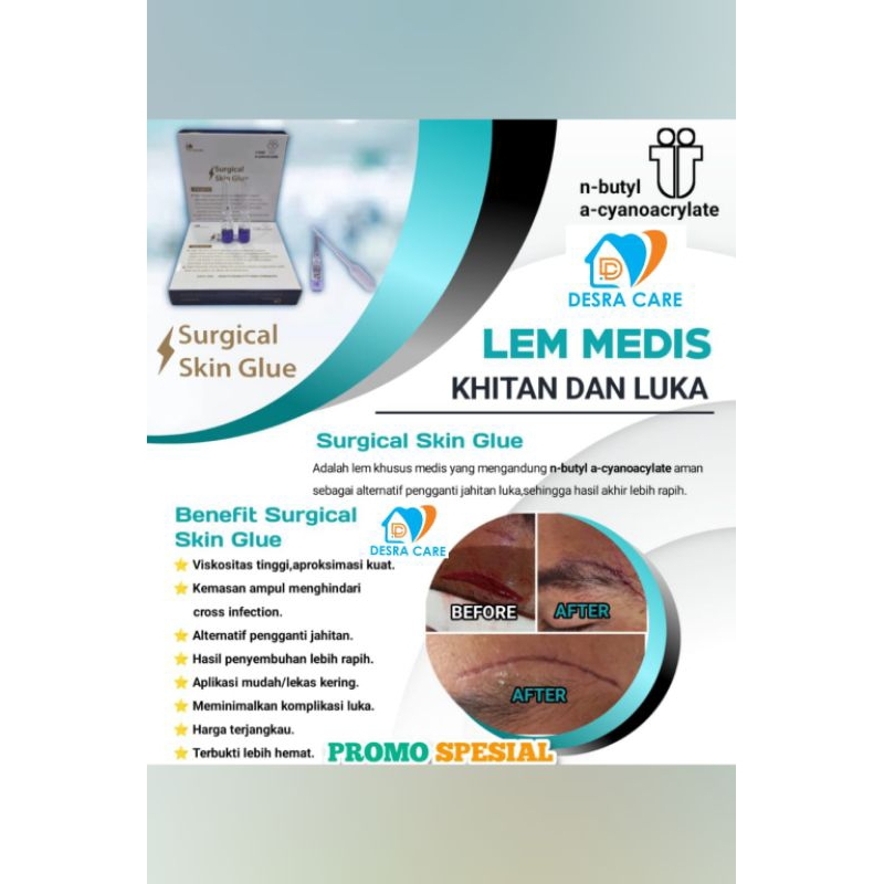 Lem Sunat SSG / Dermabond / Liquidband Termurah / Promo