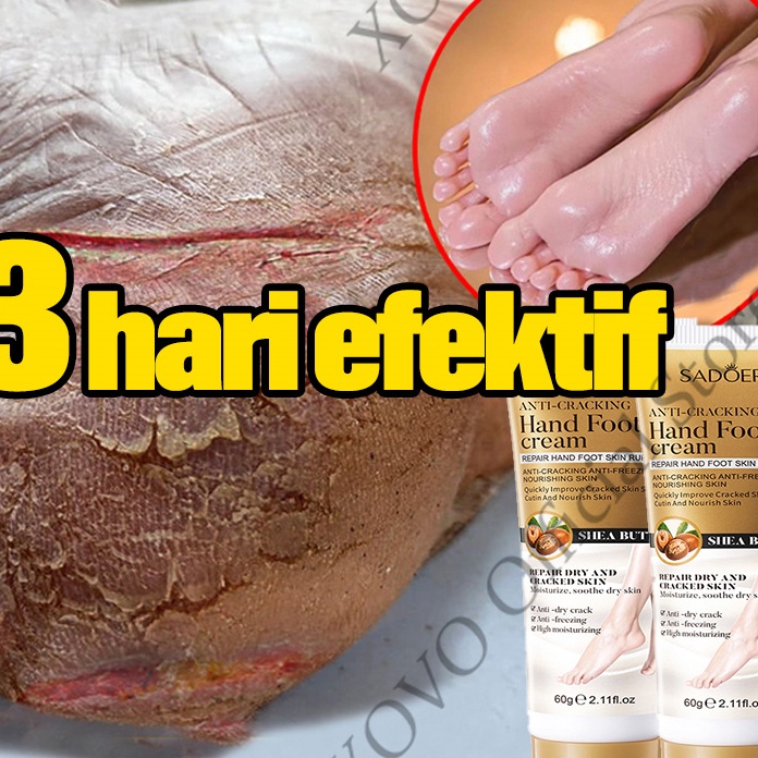 MEGA SALE kaki obat kaki pecah dan kering krim obat kaki pecah pecah 6g alat kaki pecah pecah cream 
