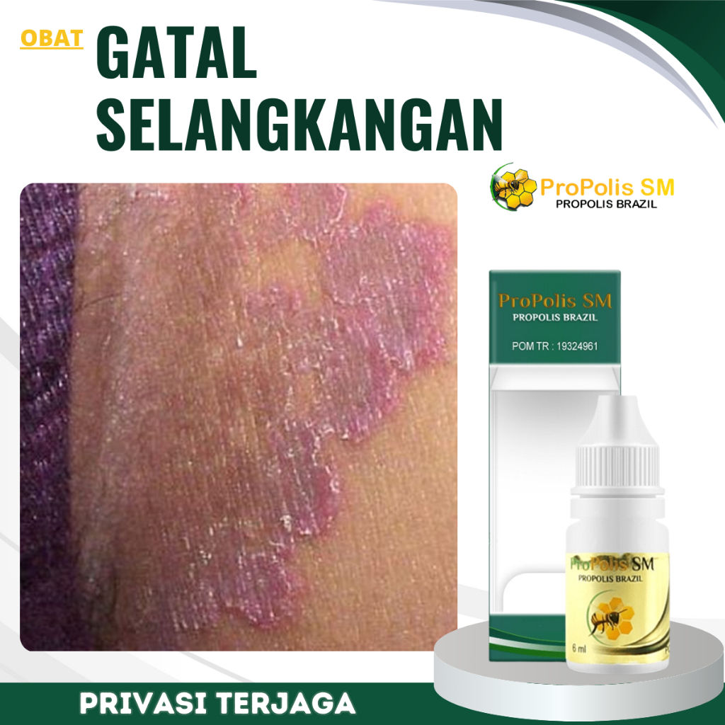 Obat Penghilang Gatal Selangkangan, obat Kurap Selangkangan, Obat Herbal Cairan Selangkangan Gatal, 