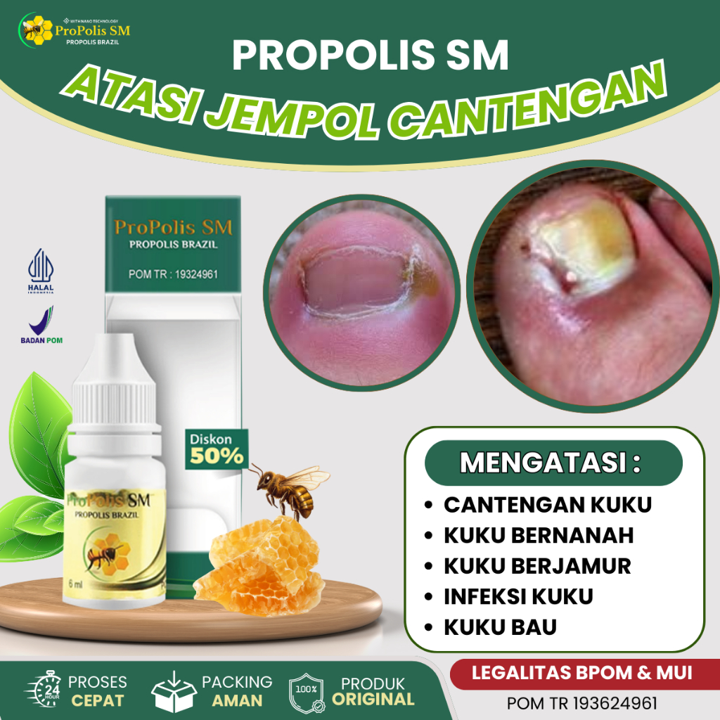 Obat Cantengan Jempol Kaki, Obat Kuku Rusak Bengkak, Berdarah, Obat Kuku Bernanah, Obat Kuku Hitam, 