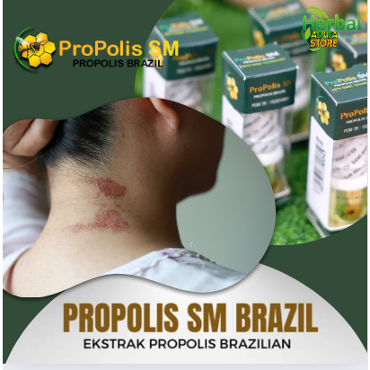 Obat penghilang Gatal Gatal, Gatal Panas, Gatal Melepuh, Gatal Kulit Melepuh, Gatal Kulit Ruam, Irit