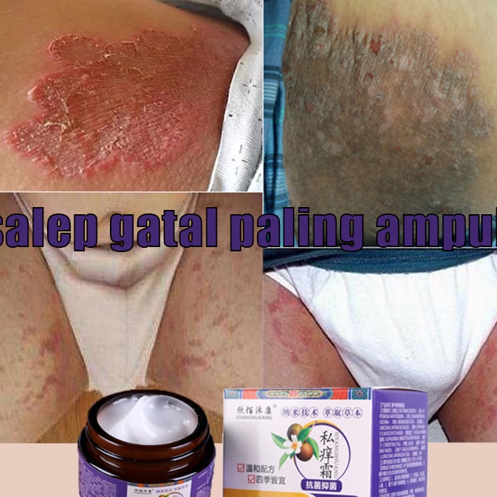 Langka Salep gatal paling ampuh obat gatal selangkangan obat gatal paling ampuh 3g Salep salep gatal