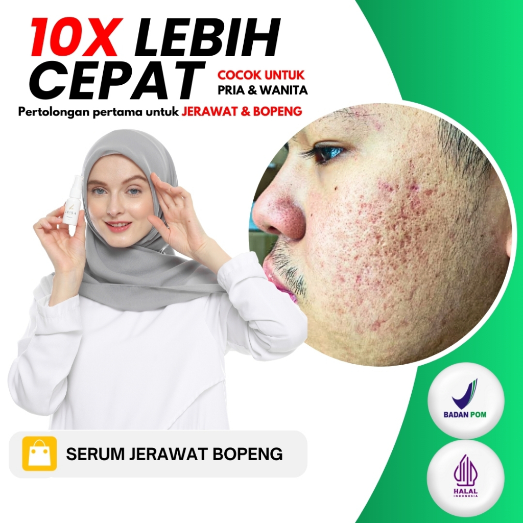 AMPUH Serum Jerawat Bopeng Penghilang Bekas Jerawat Pria Wanita Permanen BPOM Paling Ampuh Penghilan