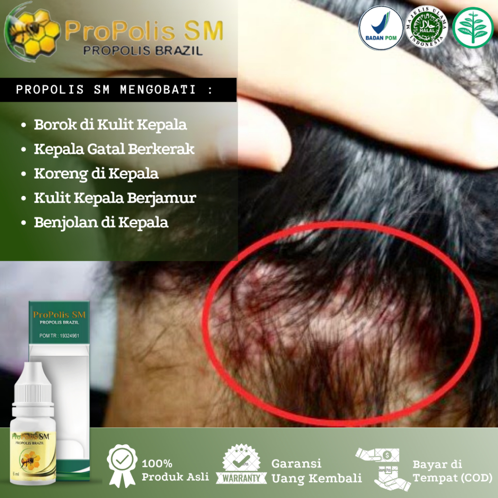 Obat Borok Di Kulit Kepala, Jamur Di Kulit Kepala, Kepala Borok, Bersisik, Kering, Koreng Di Kepala,