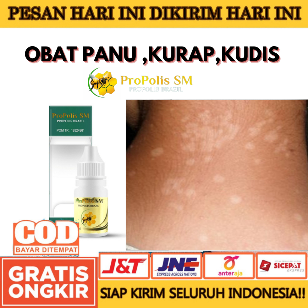 Obat Panu, Obat Hapur Kulit, Penghilang Panu, Penghilang Panu di Badan di Wajah PROPOLIS SM DI MEDAN