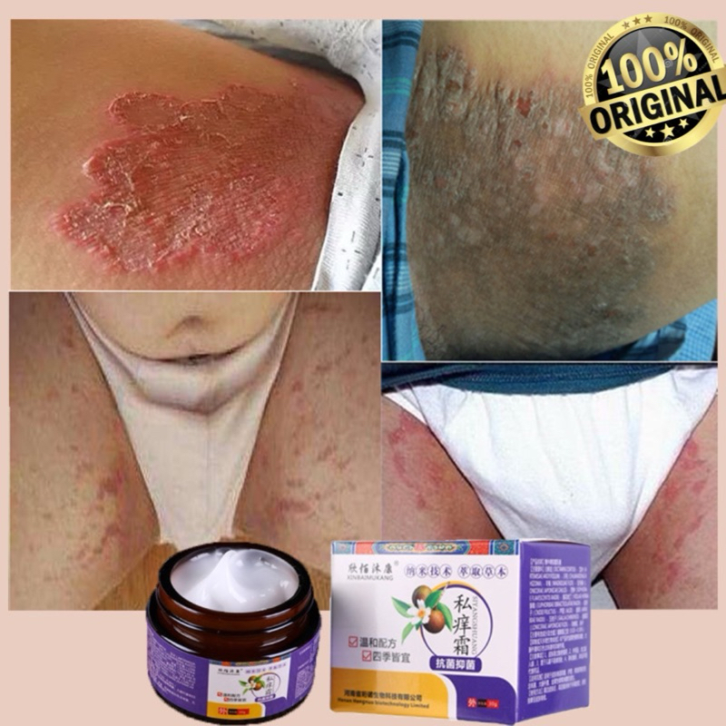 Salep Gatal Kulit Selangkangan Eksim Jamur Kadas Kurap Krim Obat Gatal Paling Ampuh China