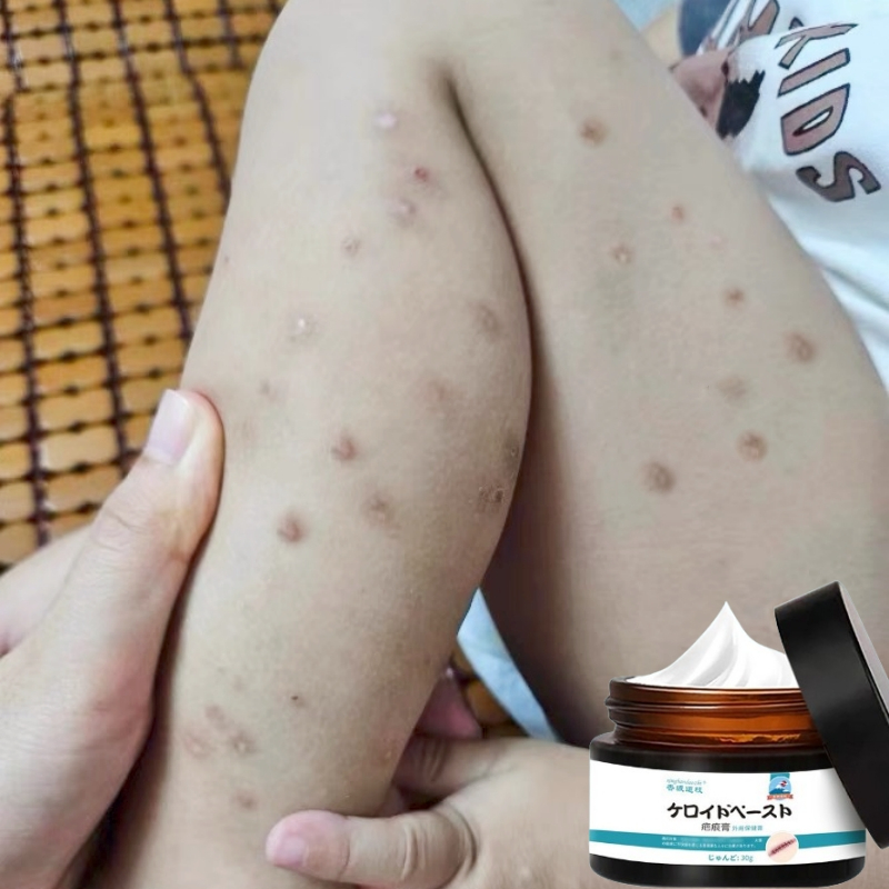 Penghilang bekas luka 30g hitam koreng Salep penghilang bekas luka Obat penghilang bekas luka Menghi