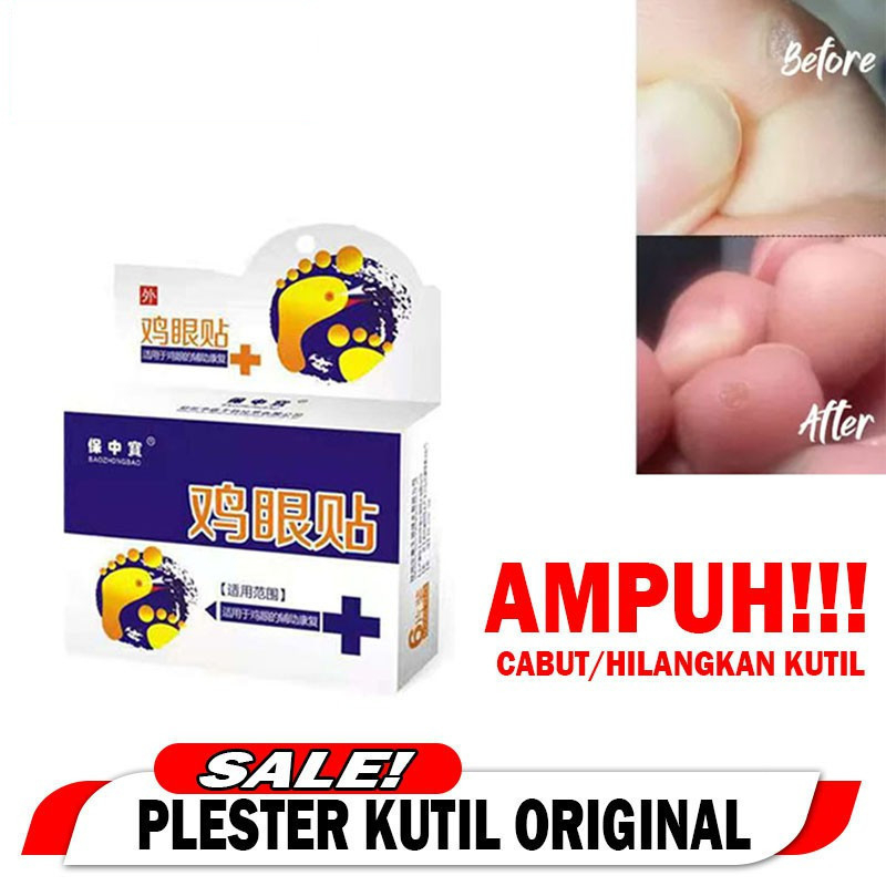 [ ISI 6 PCS  ] Obat Plester Kutil Mata Ikan Ampuh Mengobati Kutil dan Kapalan Kaki