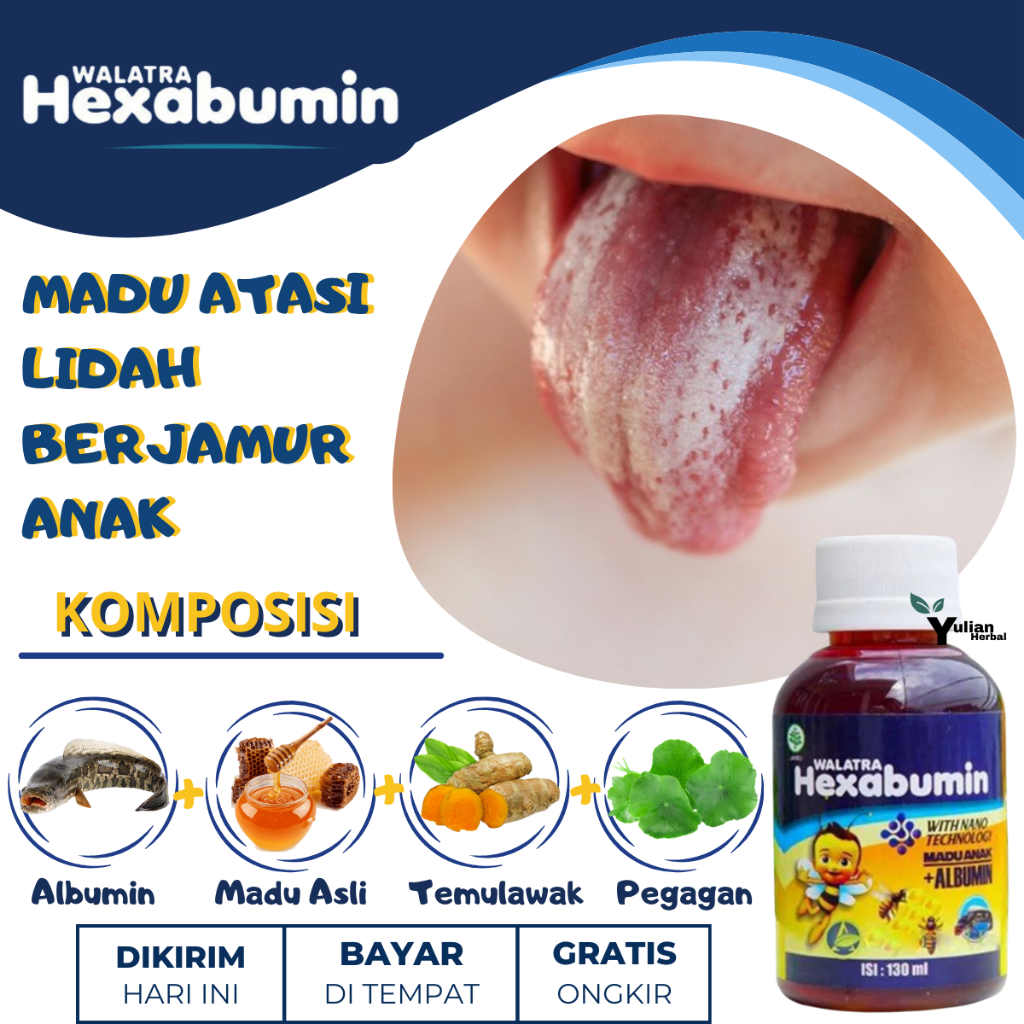 Obat Jamur Di Lidah Anak, Obat Penghilang Bercak Putih Di Lidah, Obat Kandidiasis, Obat Lidah Putih 