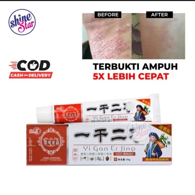 Yiganerjing 100% Original Salep Gatal Jamur Bakteri Gatal Alergi