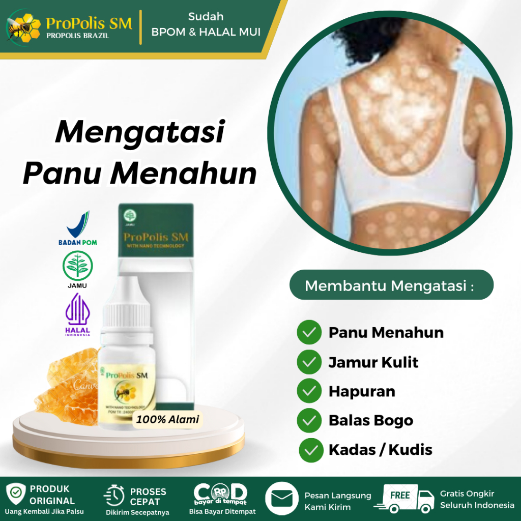 Propolis SM Obat Penghilang Panu, Kurap Kudis, Gatal Jamur Kulit, Panu di Wajah, Panu di Punggung, H