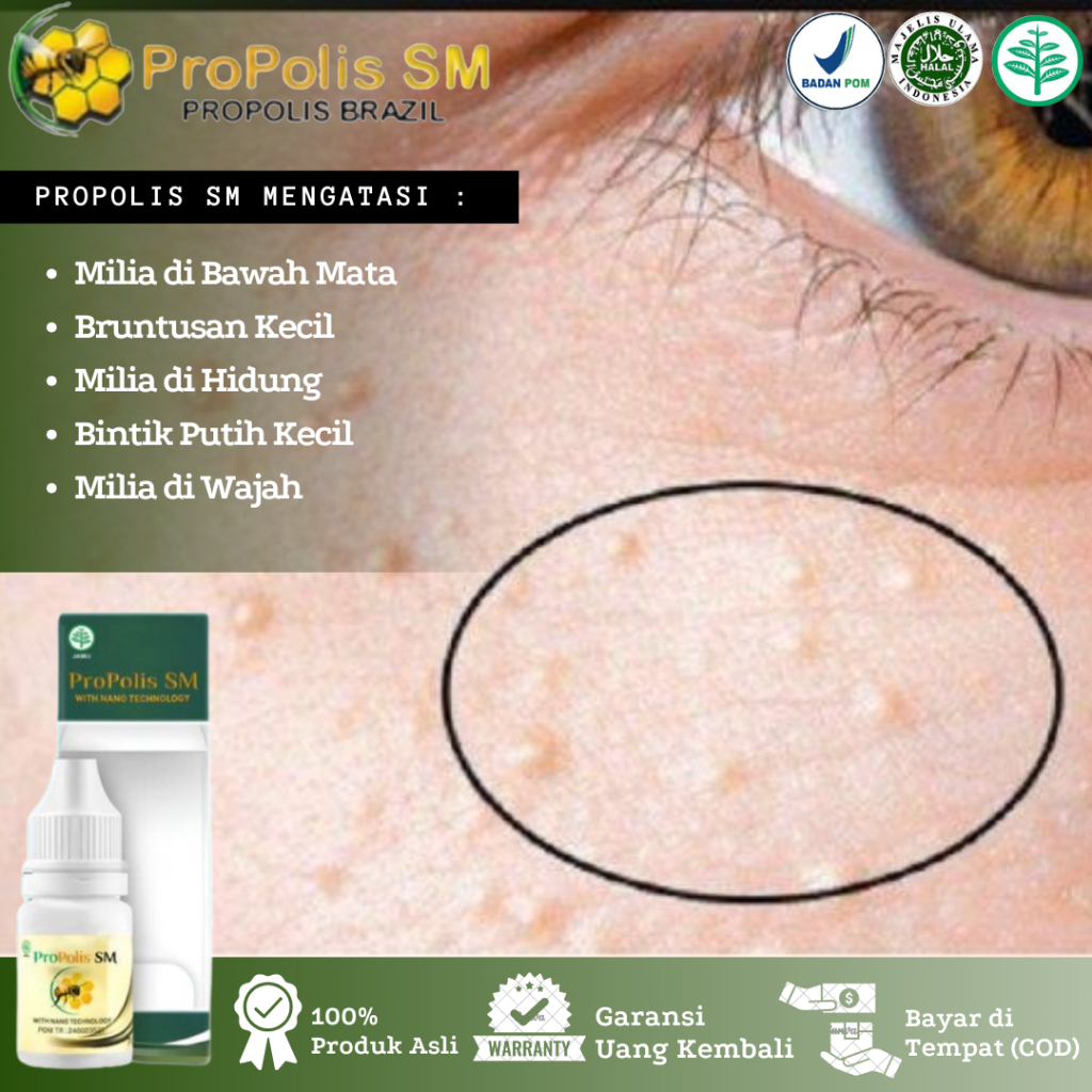 Propolis SM - Obat Penghilang Milia, Milia Di Bawah Mata, Milia Di Kelopak Mata, Jerawat Milia, Brun