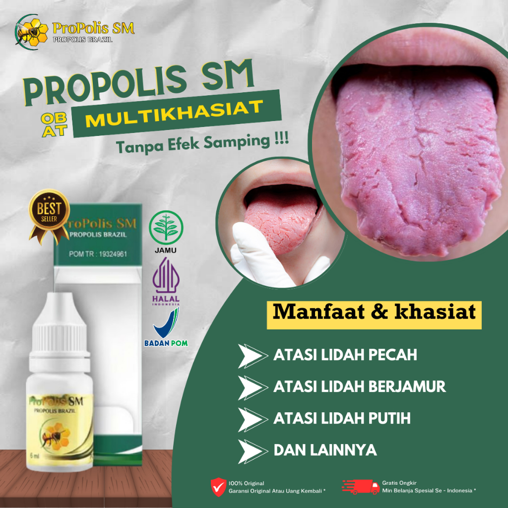 Obat Lidah Pecah Pecah, Obat Iritasi Lidah, Obat Lidah Berjamur, Obat Pembengkakan Lidah, Obat Lidah