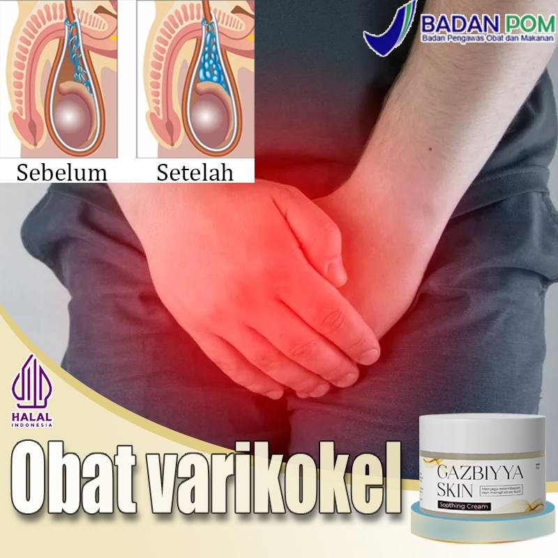 【BPOM】Obat varikokel Obat hernia Obat varises 30g Salep varises Obat herbal hernia Paling Ampuh Beng