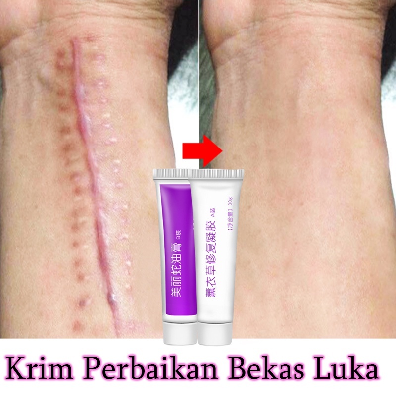 Krim Penghilang Bekas Luka Krim Penghilang Bekas Luka Stretch Marks 30g Perbaikan Penghilang Bekas L