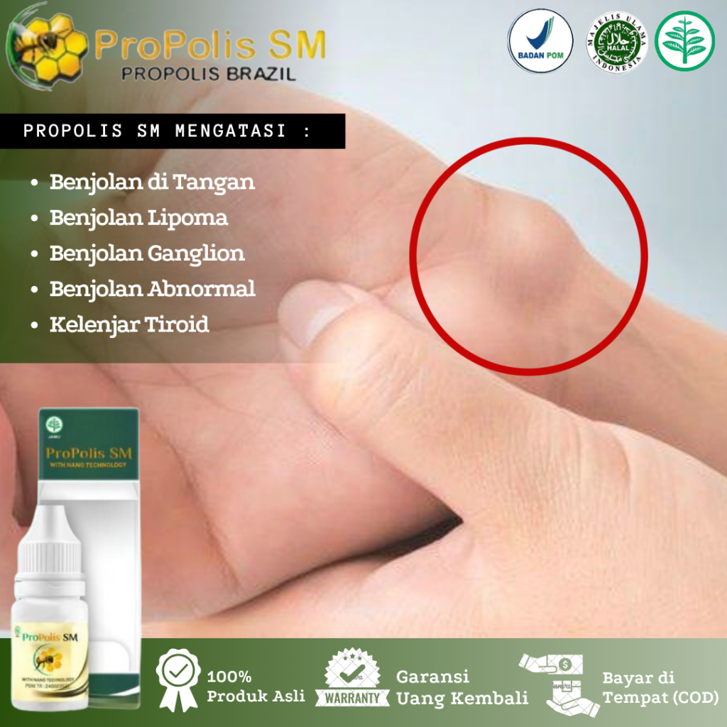 Obat Oles Untuk Benjolan di Tangan, Benjolan Ganglion, Benjolan di Pergelangan Tangan, Benjolan Lipo