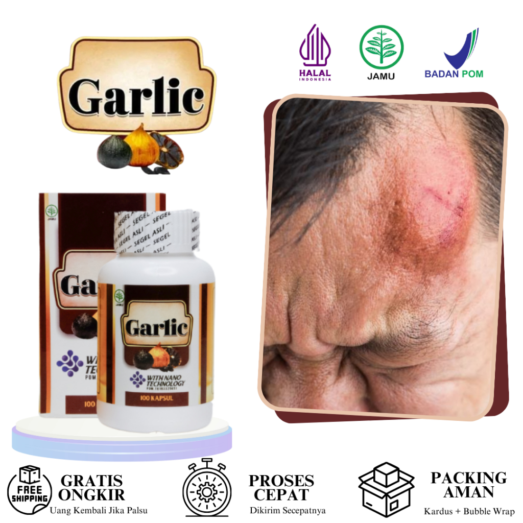 Obat Benjolan Di Kepala, Jidat/Kening, Benjolan Lipoma, Benjolan Tumor, Kista, Penghilang Benjolan D